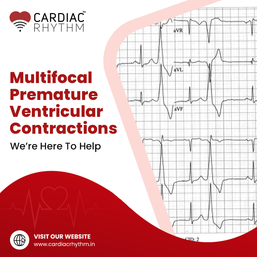 CardiacRhythmIN's tweet photo. By monitoring your heart via AI-powered cloud technologies, we can help you solve multifocal premature ventricular contractions. Contact us now
#AIHealthcare #HealthcareTech #DigitalHealth #HeartMonitoring #MedicalInnovation #CardiacRhythm https://t.co/Jn7zN4HvOM