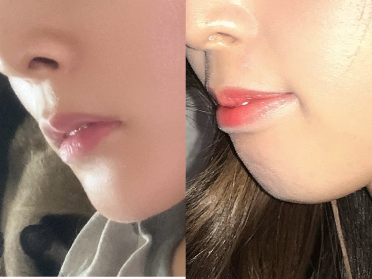 na0119nj's tweet photo. 加工アプリとか角度とかでちゃんとした比較にはなってないけど口元の印象全然違うなぁ〜
早ければ7月ごろブラオフです😌

#歯列矯正
#出っ歯
#矯正日記 https://t.co/f33wCWPG0X