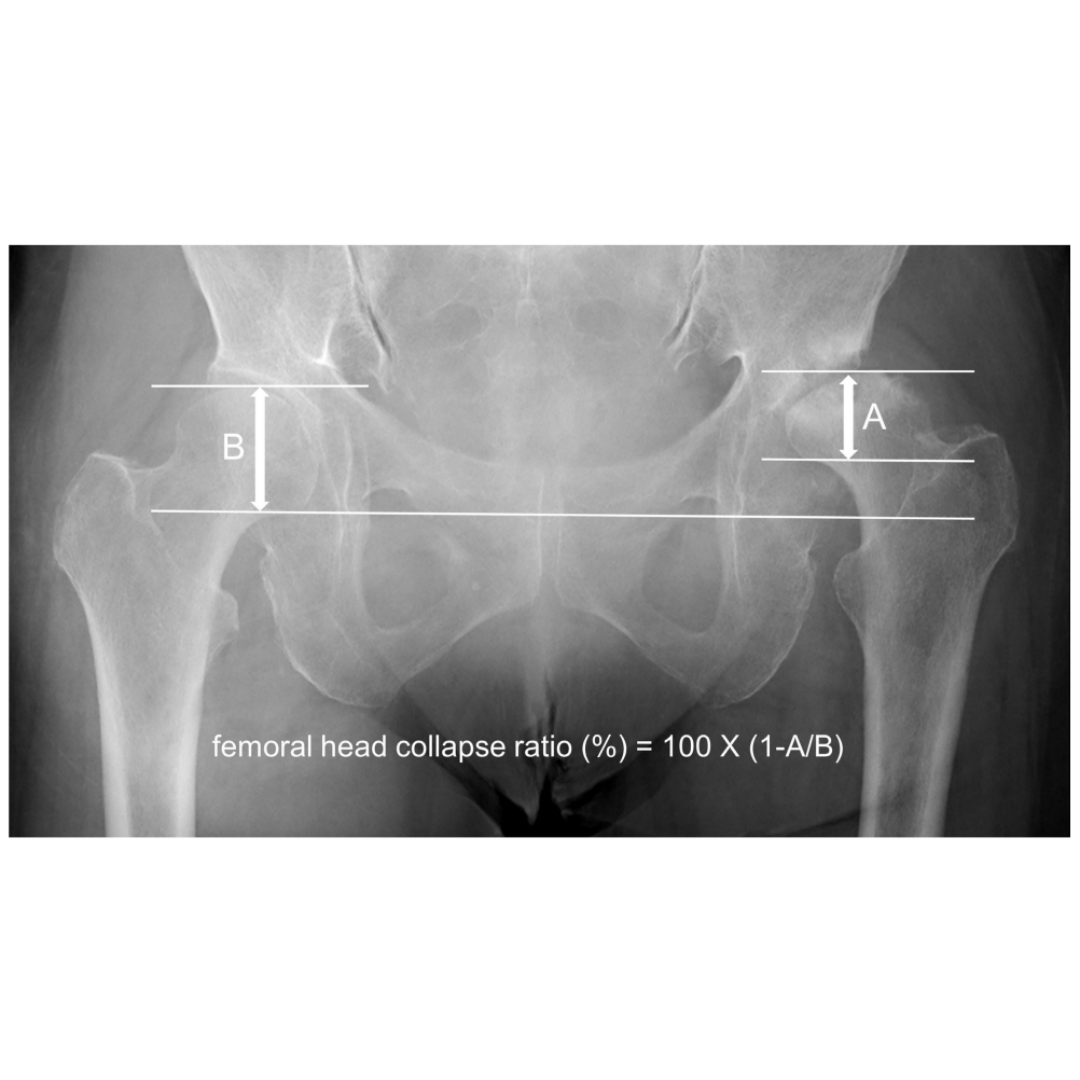 Compared with hip osteoarthritis, rapidly destructive coxopathy is potentially linked to increased pelvic tilt, decreased sacral slope, loss of lumbar lordosis, and spinopelvic mismatch as sagittal spinopelvic malalignment. #BJO #Hip #Disease ow.ly/AtLu50RcweR