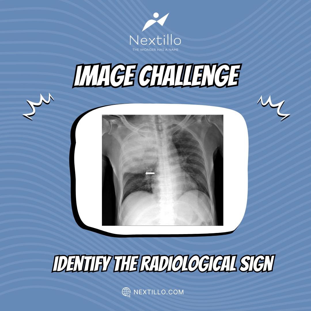 Here’s today’s #ImageChallenge! Can you identify the radiological sign in this image? 📷
#medicalmemes #fmge #fmge_mci_exam #medicalinformation #fmgequestions #fmgepreparation #medicalstudent #mbbs #radiologysigns #radiologyquiz #medtwitter #mriquestions #ctscan #MedX #MediaWatch
