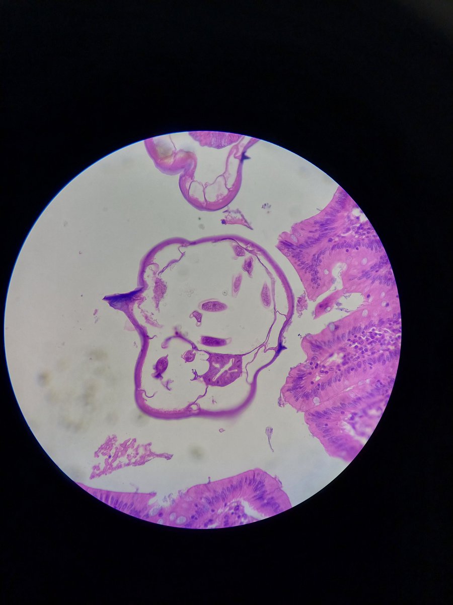 Enterobius vermicularis 
#pathoutpic