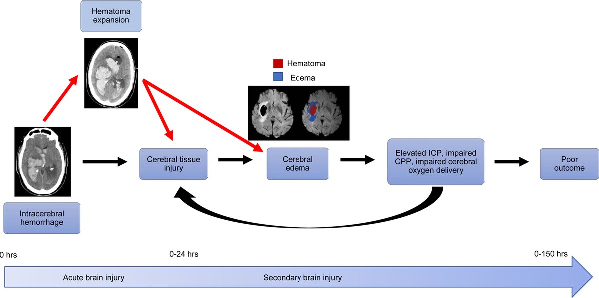 Today's Paper of the Day is on transfusion medicine approaches for spontaneous intracerebral hemorrhage patients criticalcarereviews.com/latest-evidenc… Join us to read 1 paper per day and stay up-to-date as we cover the spectrum of critical care across 2024