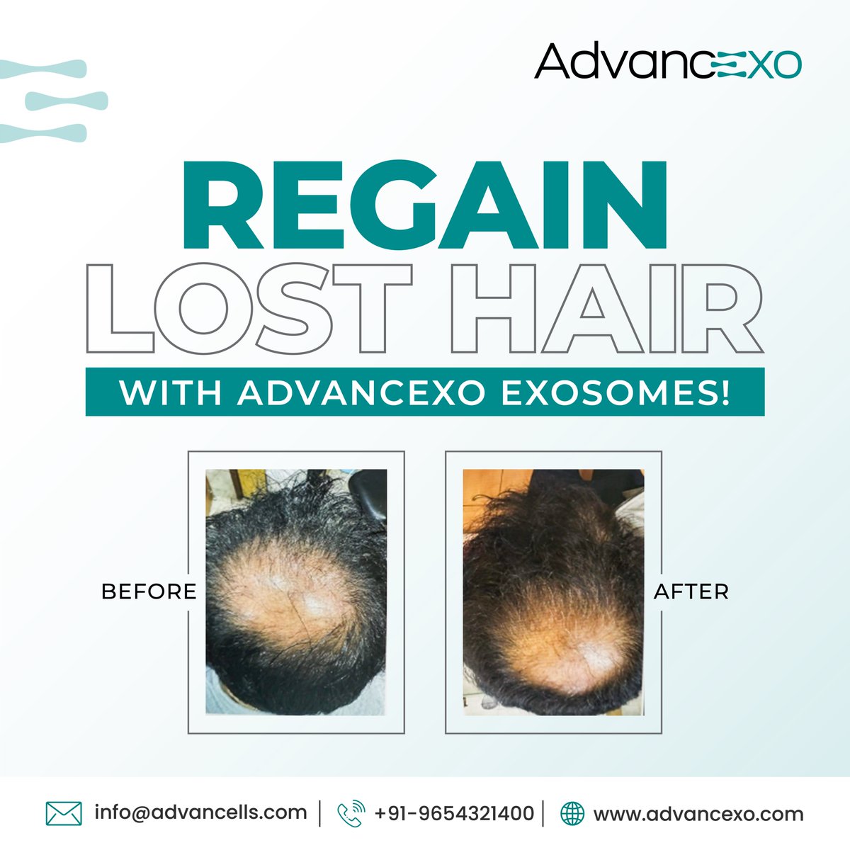 Say goodbye to #hairloss!

Advancexo #Exosomes offers a revolutionary approach to #hairregrowth. The treatment delivers exceptional results for a more confident you.
To know more, call:  +91 9654321400

#Advancexo #exosomestherapy #testimonials #hairlosshelp #hairlosssolution