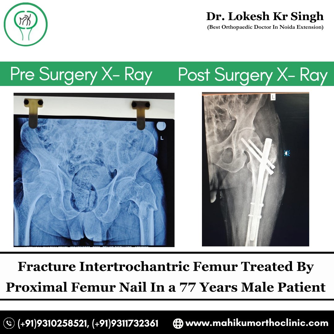 Fracture Intertrochantric Femur Treated By Proximal Femur Nail In a 77 Years Male Patient.
-

Book your appointment @(+91)9310258521, (+91)9311732361
-
#MahikumOrthoClinic #Orthopaedicclinic #fracturesupracondylarlefthumerus #surgery #handsurgery #OrthopedicClinic #Orthopedics