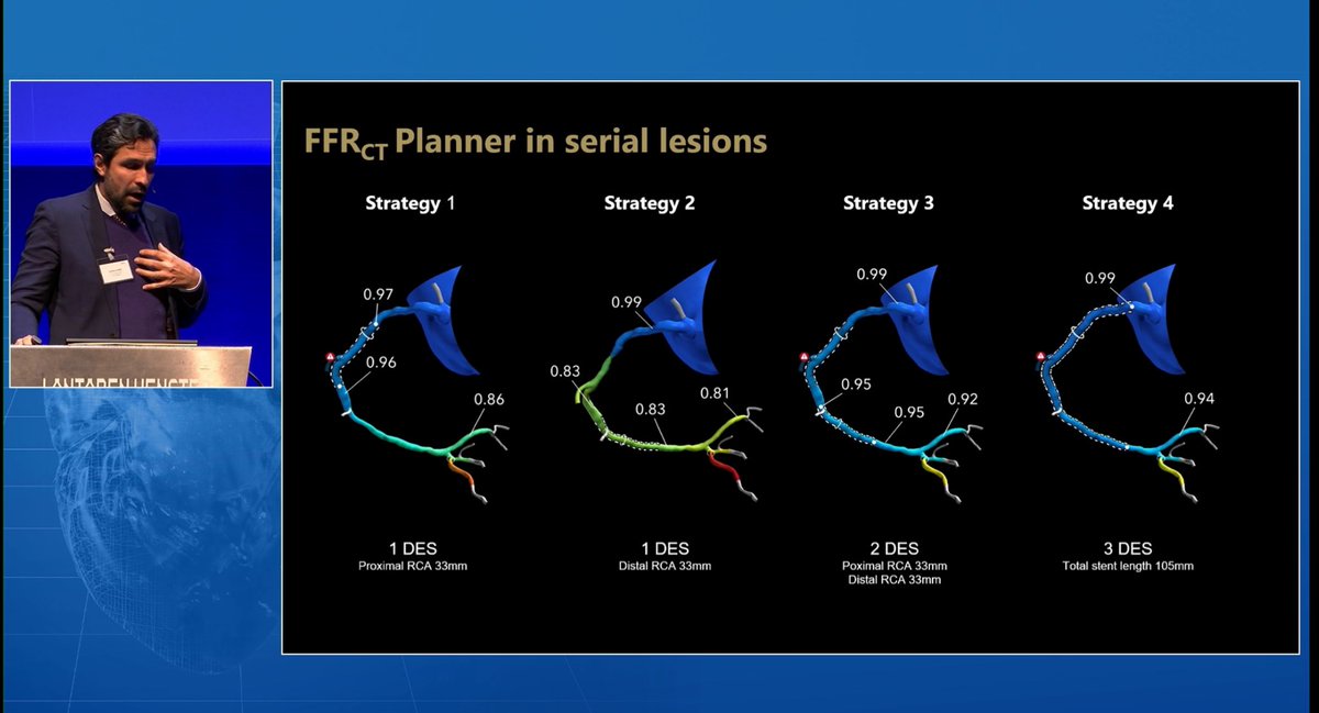 monaltiren's tweet photo. #CoronaryPhysiology
#IPCI 2024
@ColletCarlos
is E V E R Y W H E R E
IPCI meeting, Rotterdam
18-19 April
P C I P L A N N I N G
Non-invasively
B E F O R E the cath lab
with F F R c t https://t.co/NITFSOVH1Y