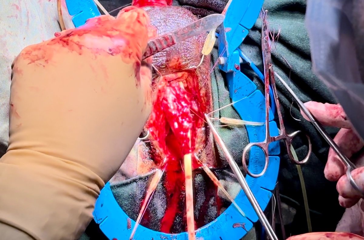 Back in #Lilongwe for a week of urethroplasty with <a href="/MabediCharles/">Charles Mabedi</a> problem is Charles is v good so I’m only doing the v difficult ones this time round! Redo BPAs. Preputial tube for bulbar necrosis. Tiring but fun! Tanzania in November 👍🏻<a href="/BAUSurology/">BAUS</a> <a href="/ISORU1/">ISORU</a>