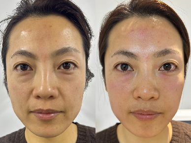 newangiemed's tweet photo. 📷📷📷Machines lined up for experience at beauty shows
📷Pulselift face machine
📷7 patches, forehead, under eyes, cheeks, chin, neck
📷20 minutes results
📷Contact us for machine details https://t.co/AwAARN9i5P