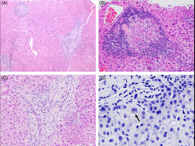 ClinicalLiverDisease (@cld_learning) on Twitter photo <a href="/RobertFontanaMD/">Robert Fontana</a> & colleagues <a href="/MichiganLiver/">Michigan Hepatology</a> guide us through the challenging (& common) scenario of how to establish a diagnosis of DILI in patients on chemotherapy in a stepwise fashion
A case of PKI-associated cholestatic granulomatous hepatitis:
journals.lww.com/cld/fulltext/2… <a href="/RobertFontanaMD/">Robert Fontana</a> & colleagues <a href="/MichiganLiver/">Michigan Hepatology</a> guide us through the challenging (& common) scenario of how to establish a diagnosis of DILI in patients on chemotherapy in a stepwise fashion
A case of PKI-associated cholestatic granulomatous hepatitis:
journals.lww.com/cld/fulltext/2…