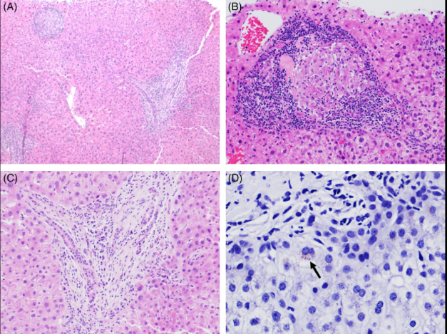 @RobertFontanaMD & colleagues @MichiganLiver guide us through the challenging (& common) scenario of how to establish a diagnosis of DILI in patients on chemotherapy in a stepwise fashion A case of PKI-associated cholestatic granulomatous hepatitis: journals.lww.com/cld/fulltext/2…