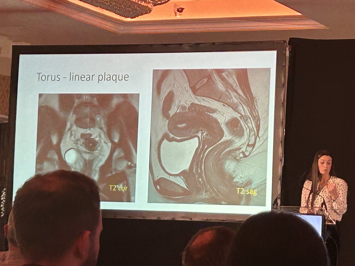 Brilliant presentation by Dr Anne Buckley from @saoltagroup Galway University Hospital on the important topic of endometriosis & its complications @radiologyirl Combined Spring Meeting So important for patients that we are aware of the subtle early findings 🙌🏻