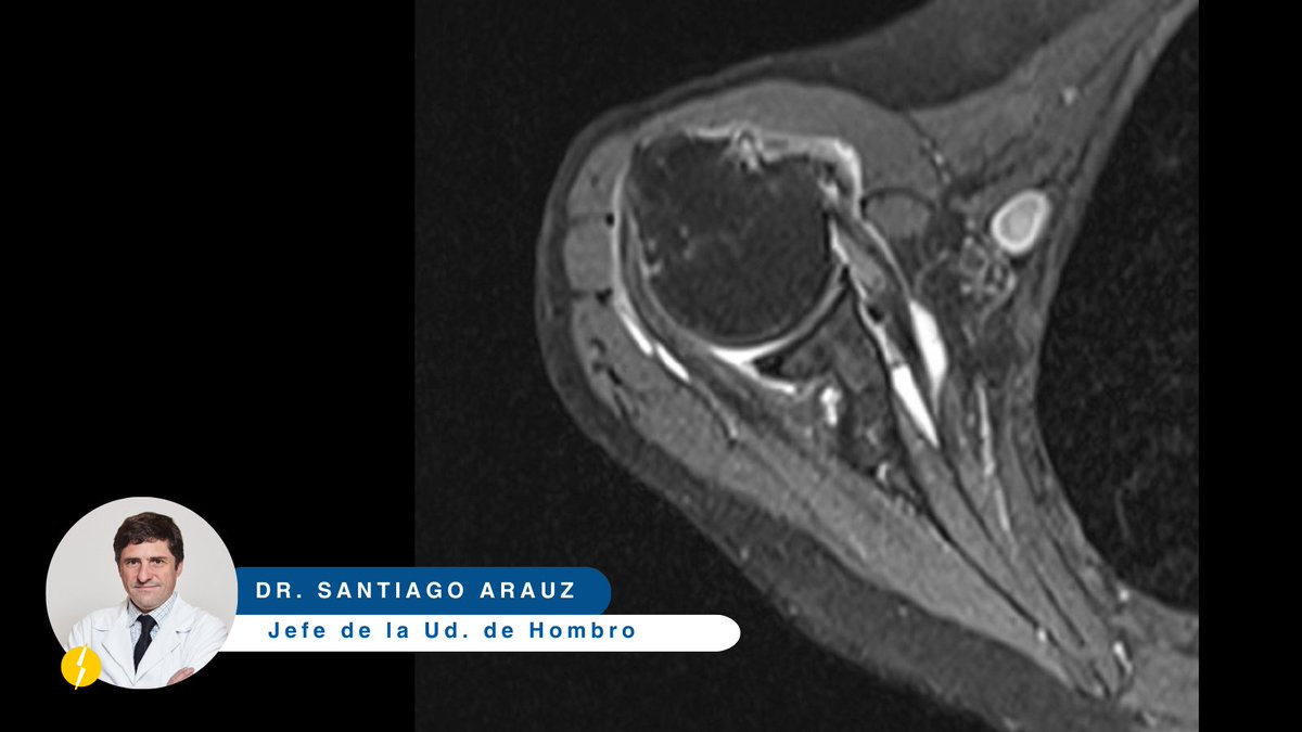 💪🏻💥Subluxación del bíceps #PLB en el #SSC 👨🏻‍⚕️Vía Dr. @arauz_santiago - #UdHombro #ClinicaCEMTRO