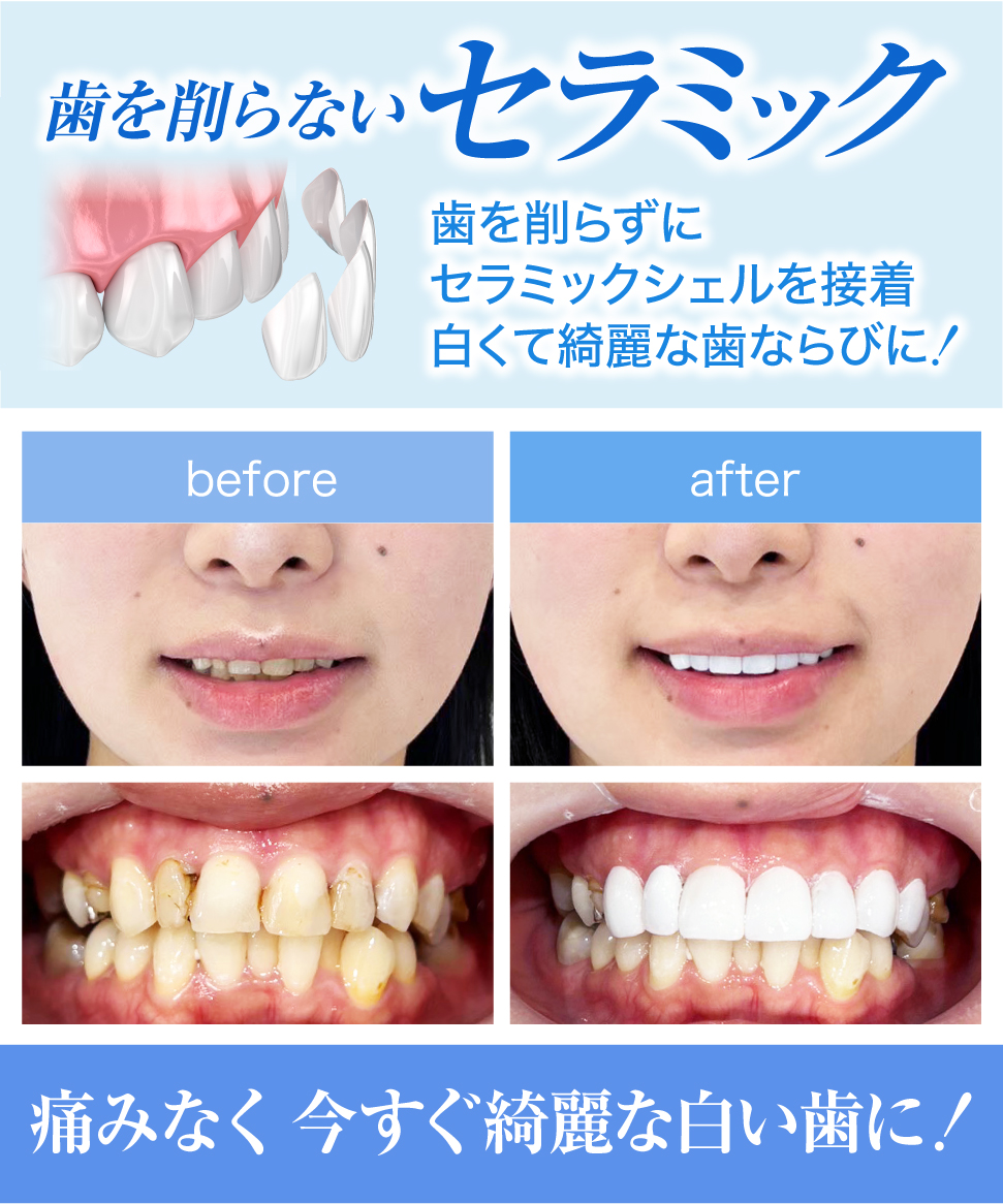 白くて綺麗な歯並びに✨ ＼ ✓削らないセラミック治療「カブキホワイト」は歯を削らずに薄いセラミックを歯の表面に接着、大切な天然歯を残して美しい歯並びと 綺麗な色に😁 #セラミック #ラミネートベニヤ #セラミック矯正 #カブキホワイト ▽詳細はこちらから https://t ..., image size:971x1166