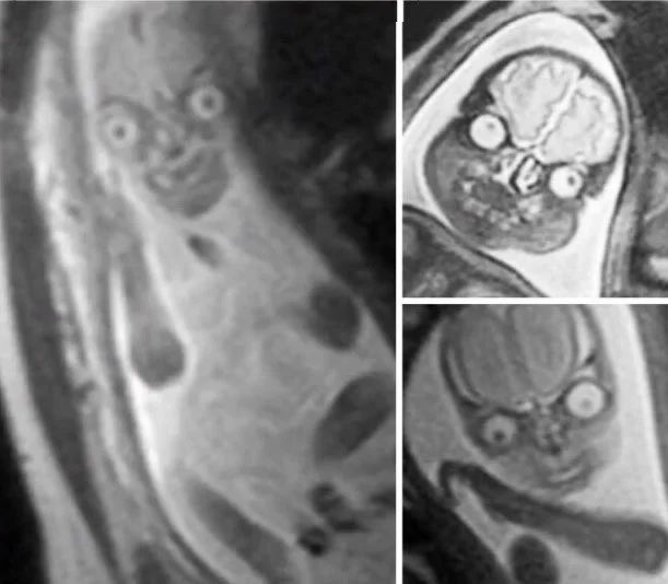 This is what a fetus looks like in an MRI.

[read more: buff.ly/3QY48Q4]