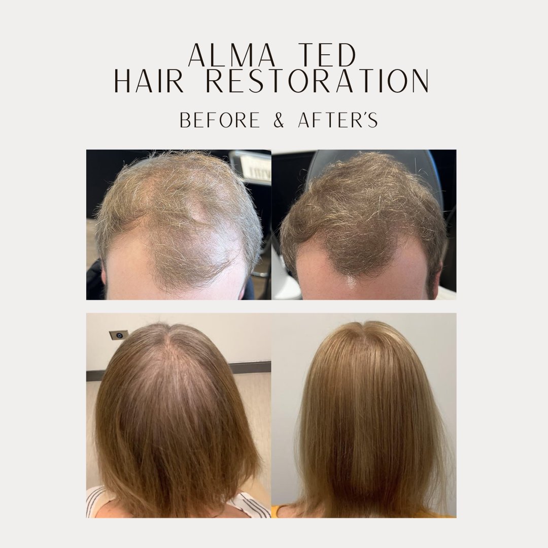 Ready to embark on your journey to hair rejuvenation? Tap the link in my bio for more information and to book your consultation today! ✨ #hairrestoration #hairrejuvenation #medicalaesthetics