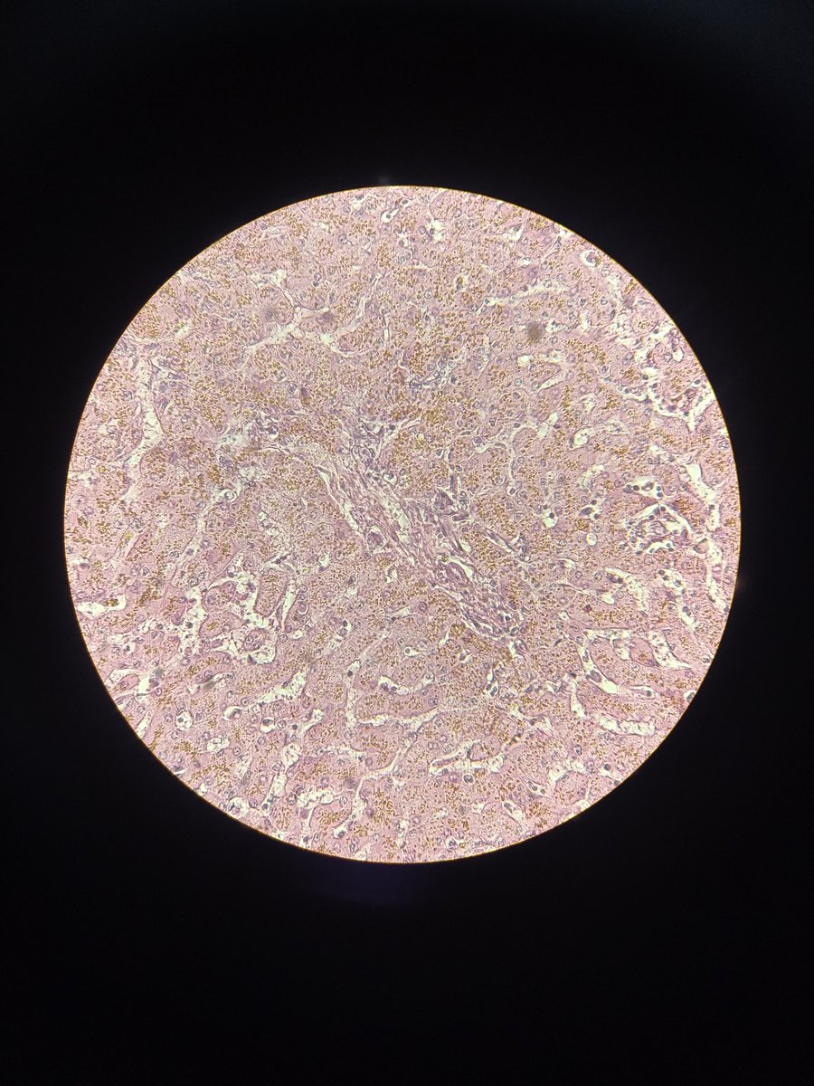 Microphotography showing intracellular golden yellow brown granules (Hemosiderin laden macrophages)
Hemosiderosis of the liver. H and e stains (medium power) #pathoutpic