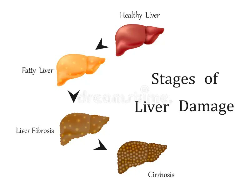 A patient just told me: 'I stopped drinking after you showed me the pictures of a liver with fibrosis and cirrhosis. I understood my condition'. I feel that is didactic to show such images, and tell them that there is hope to stop/reverse the disease. #livertwitter #MedTwitter
