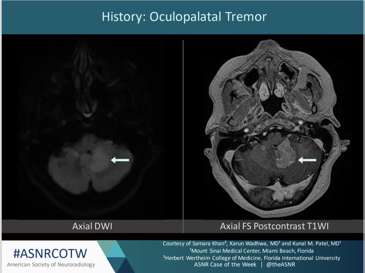 ASNR COTW #192 Hx: Oculopalatal Tremor NO SPOILERS! Give hints in the form of Gifs or answer attached poll. Answer in 24 hours. #neuro #neurorad #erad #radres #FOAMed #FOAMrad #medtwitter #ASNRCOTW