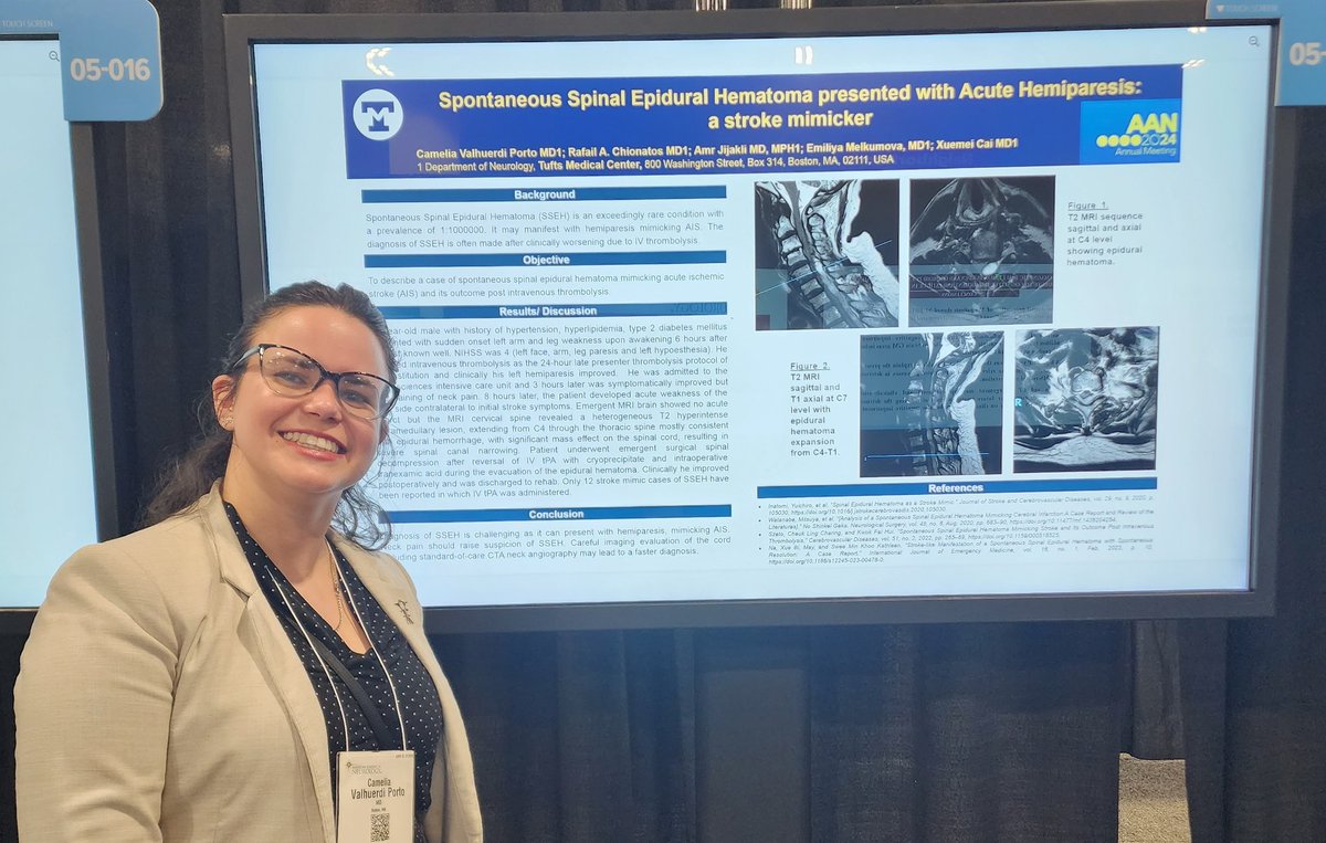 Great discussion from our poster presentation on a case of Spontaneous Epidural Hematoma, a stroke mimicker I would never forget. Thank you to our great mentors at @TuftsMCNeuro and to my coauthors @RChionatos @Amrjijakli #AANAM #AAN2024