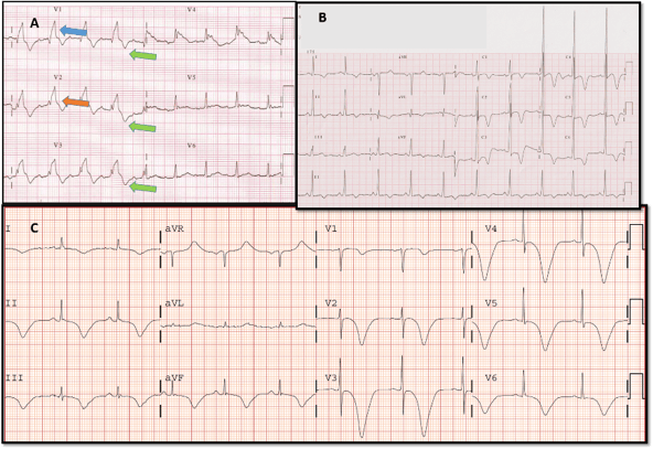 🆕 ¿Qué otras cosas además de la isquemia producen ondas T negativas? 💊💛#pildoraecg 📌cardioteca.com/pildoras-ecg/5… #cardiologia #cardiotwitter #ECG @HiguerasJavier