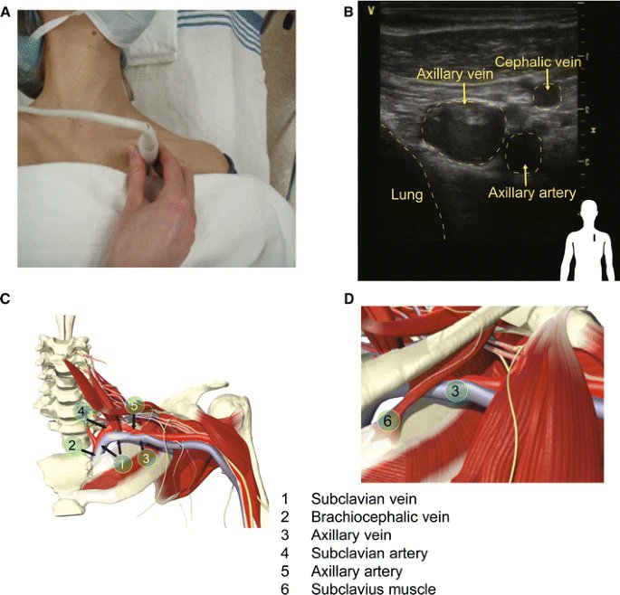 Subclavian and axillary vessel anatomy: a prospective observational #ultrasound study. #FOAMed #POCUS #FOAMcc 🔗 link.springer.com/article/10.100…