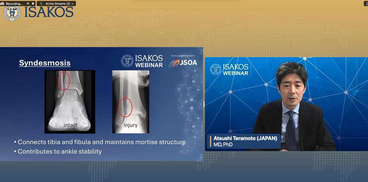 Join us to discuss The State of the Art of Syndesmosis Injury with Atsushi Teramoto, MD, PhD JAPAN #ISAKOSWebinar with JSOA: Advances in the Athlete’s Foot and Ankle isakos.com/Webinars