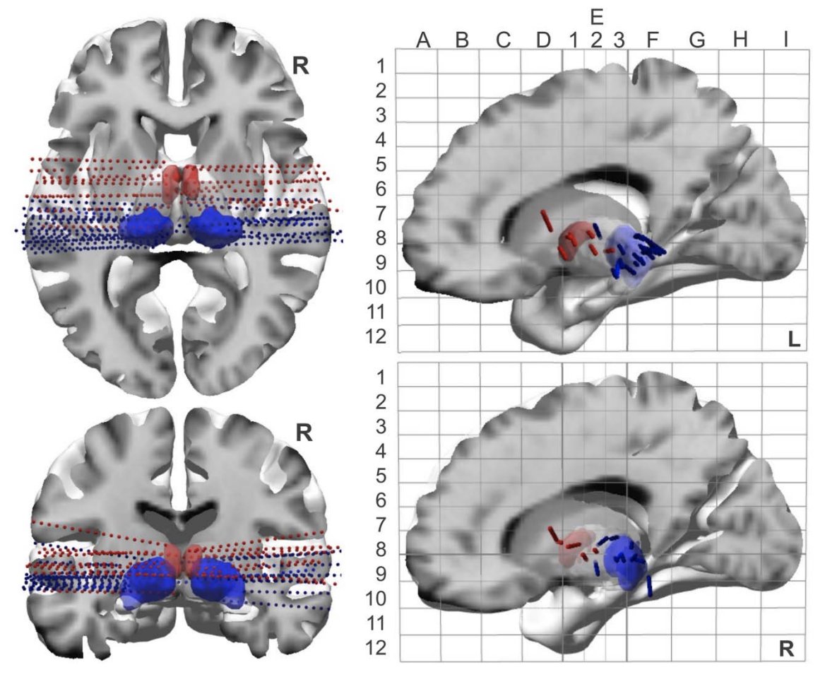ASSFNeurosurg's tweet photo. A study from @PittNeurosurg in @NeurosurgeryCNS reported cortical and thalamic sEEG was safe and useful for assessing the efficacy of thalamic neurostimulation in drug-resistant epilepsy.

@AANSNeuro @CNS_Update 
#ASSFN #neurosurgery #MedTwitter 

https://t.co/nXbsZYt832 https://t.co/cGWAy5rHnK