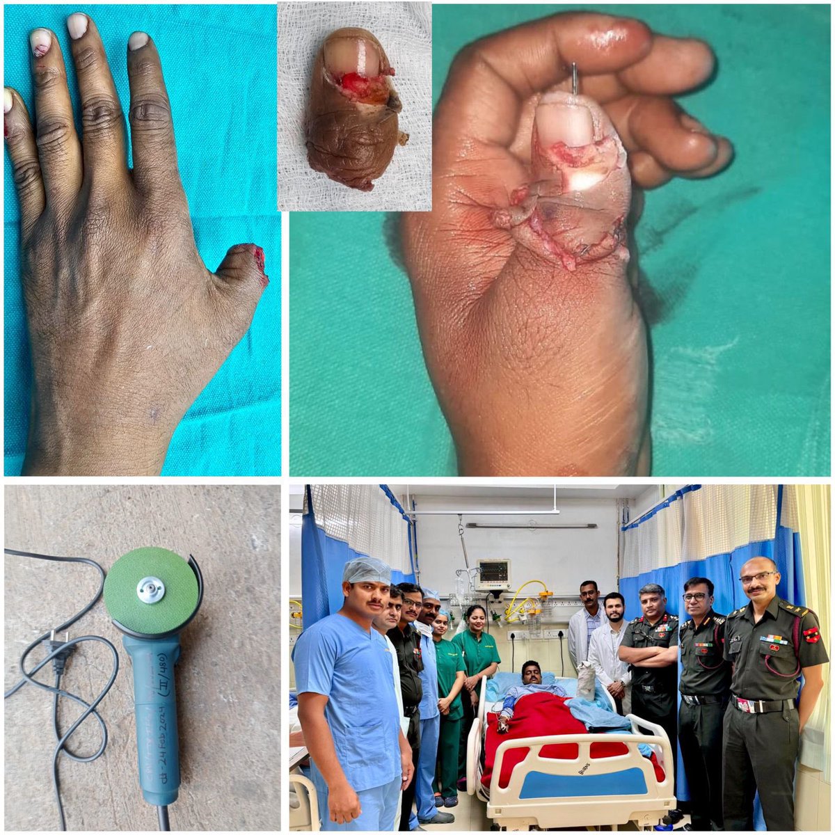 #CommandHospital #Pune, successfully performed reconstructive surgery on a 29-year-old serving soldier who sustained the amputation of his left thumb while operating an electric grinder at Devlali Cantonment on April 15th. The team conducted reattachment microsurgery on the