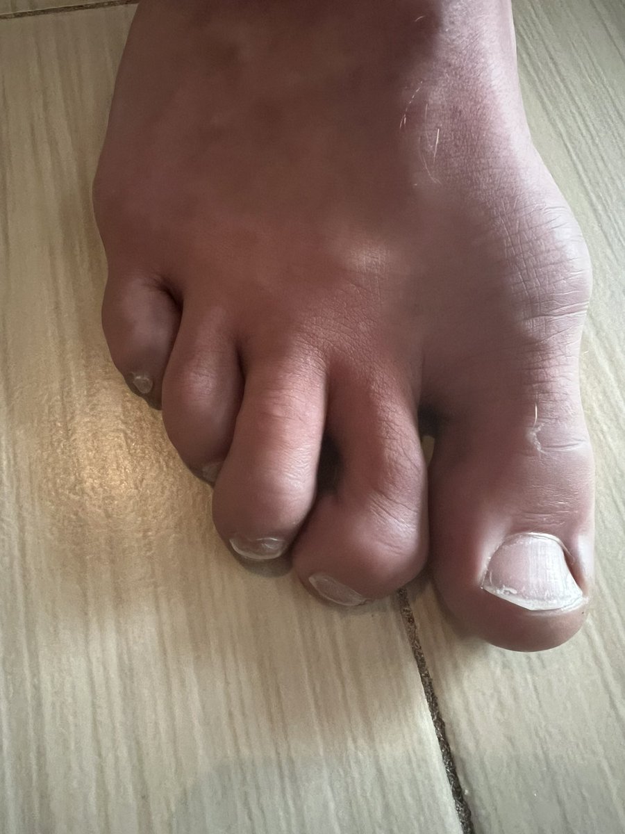 Ashley thinks my feet don’t look right. I disagree. What do you all think? They’re … like everyone else’s right? For more exclusive 🦶 pics, onlydad.gov.uk.com.co/meatbeeffeet Streams today: 1030am + 3pm est on Twitch