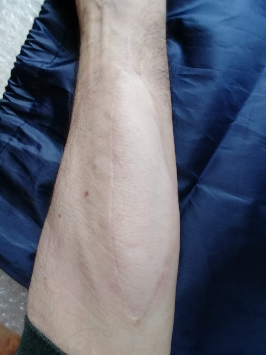 Having a Sentinal Skin Flap as part of a solid organ transplant might seem daunting to pre surgery patients, but just look how the skin settles in its new home. This allows patients to identify any early rejection and seek treatment. #lifeonextratime #organdonation #surgery