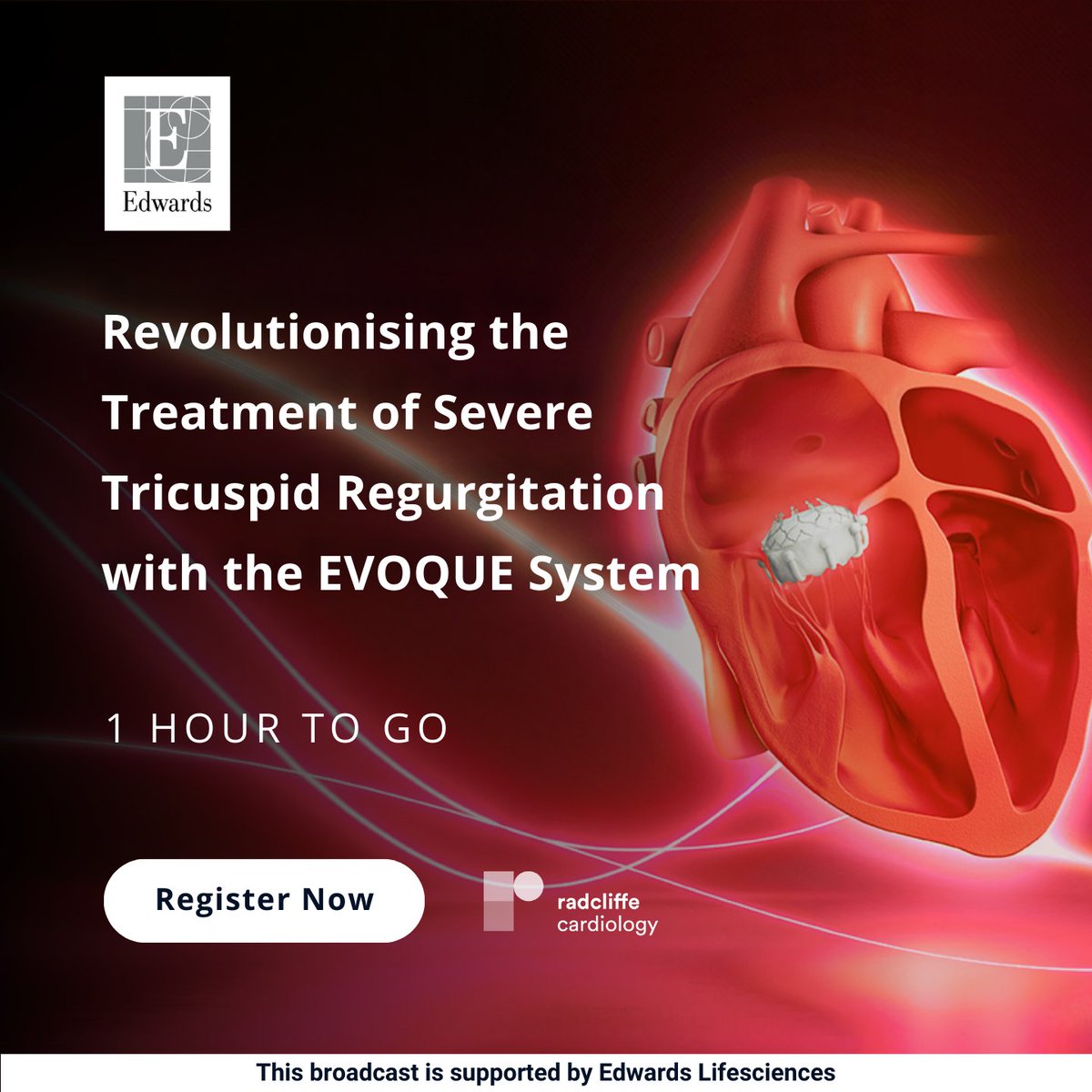 ⏰ 1 HOUR TO GO ⏰ Revolutionising the Treatment of Severe #Tricuspid Regurgitation with the #EVOQUE System 🔗 ow.ly/UbWP50Rg0fI 📚Patient selection criteria 📈The latest clinical evidence for #TTVR using the EVOQUE system 🏥Live imaging and procedure analysis using MPR
