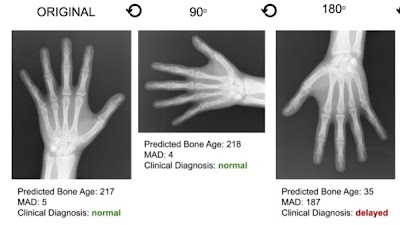 A #DeepLearning model to estimate bone age from kids' hand xrays lacked robustness to variations in images doi.org/10.1148/ryai.2… @SamSantomartino @EBeheshtian @UM2ii #MSKRad #AI #MachineLearning
