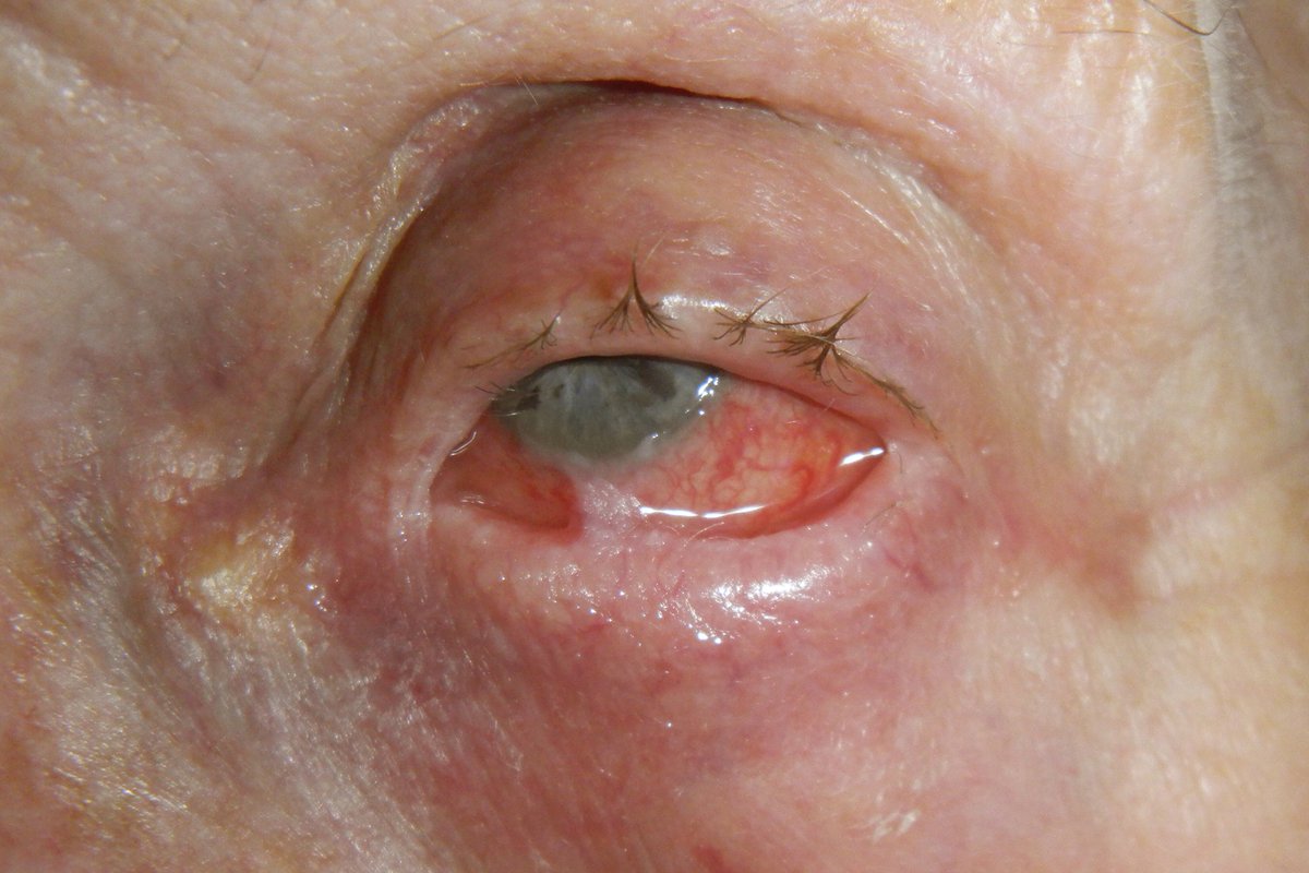 High-risk #ExtraocularManifestations, #CornealScarring, and persistent inflammation are risk factors for relapse, progression, and #VisionLoss from #OcularMucousMembranePemphigoid. Study in Ophthalmology @AAOjournal @aao_ophth

Read here: brnw.ch/21wIXal

#Ophthalmology