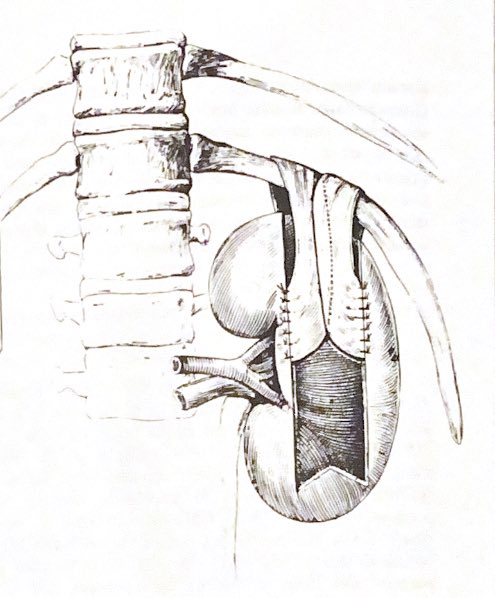 La néphropexie avec fixation de la capsule à la 12ème côte a autrefois été proposée pour traiter la ptose rénale ! Papin 1934