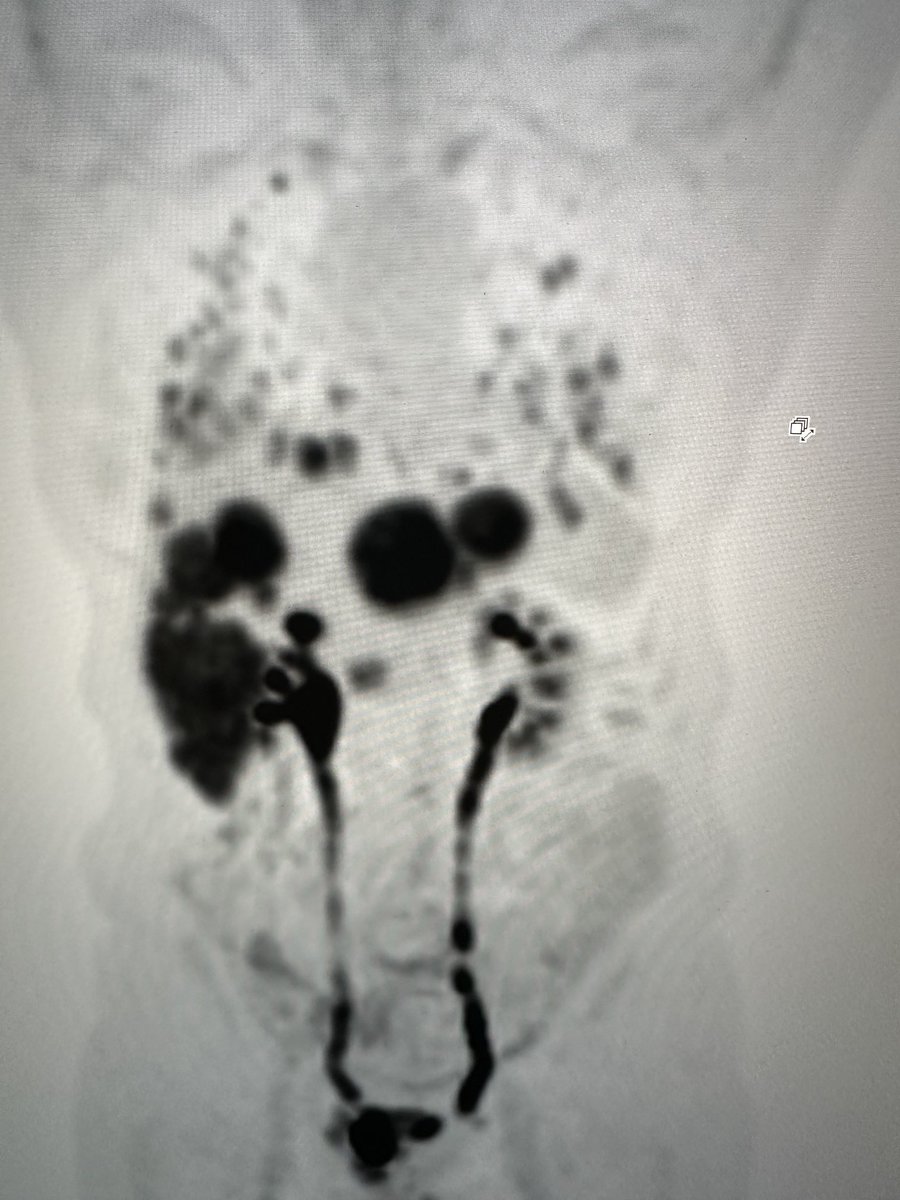 You work all your life towards retirement. Then, two weeks after your retirement party, you get worked up for hematuria, bladder carcinoma and then go for your staging PET and then not too long after, goodbyes to the world. See it every day.😞