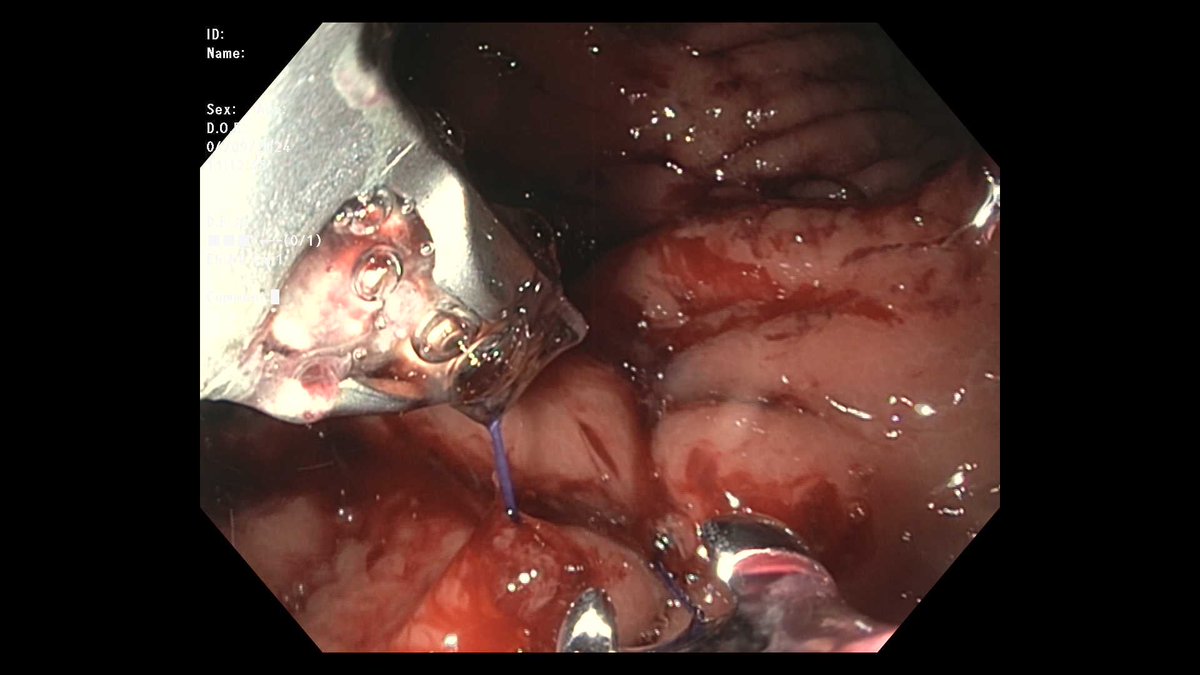 Successful first Overstitch case in Canada 🇨🇦 . Complex, chronic duodenocutaneous fistula. Performed endoscopic pyloric exclusion. no delayed leak and patient having liquid diet without external drainage (shared with permission) many thanks team and my mentors, exciting times