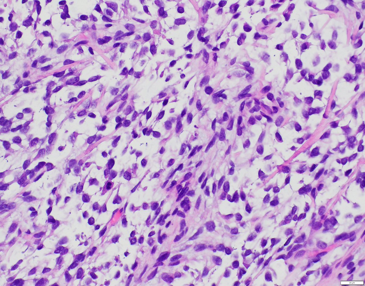 Kidney mass in a young patient.
Based on histology and likely diagnosis, what is the most common molecular genetic alteration in this tumor? 🤔
#pedipath #kidneypath #molecpath #pathology