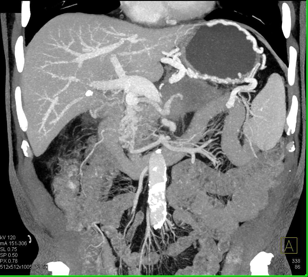 Adenocarcinoma Pancreas with Metastases to the Left Gluteal Muscles: ctisus.com/teachingfiles/…
