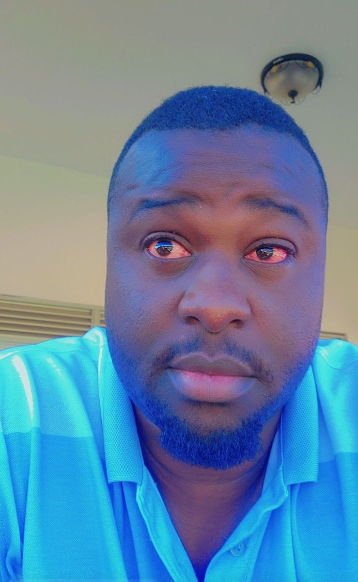 VJJunior_256's tweet photo. Attention
#Conjunctivitis also known as "red eyes,"is going around. See a doc if your eyes 'r red &amp; itchy. Becareful not to spread it to others, especially children. PAINFUL 

I know this isn't the most pleasant topic,but wanted to raise awareness and help keep everyone healthy https://t.co/4byyAnQwJz