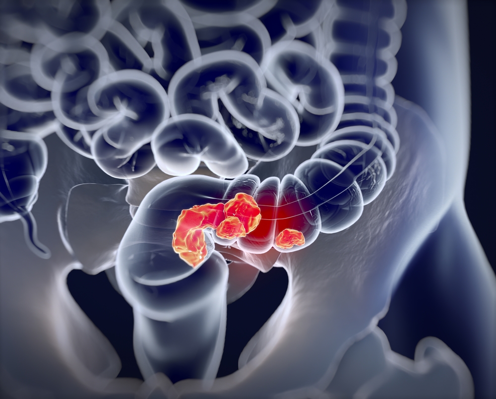 New #JournalofPharmaceuticalAnalysis study finds that #ginsenosideRk3 inhibits #ColorectalCancer formation by enriching beneficial #gut #bacteria and regulating #InnateLymphoidCell #ImmuneResponses: ow.ly/G7Hk50RiIj0