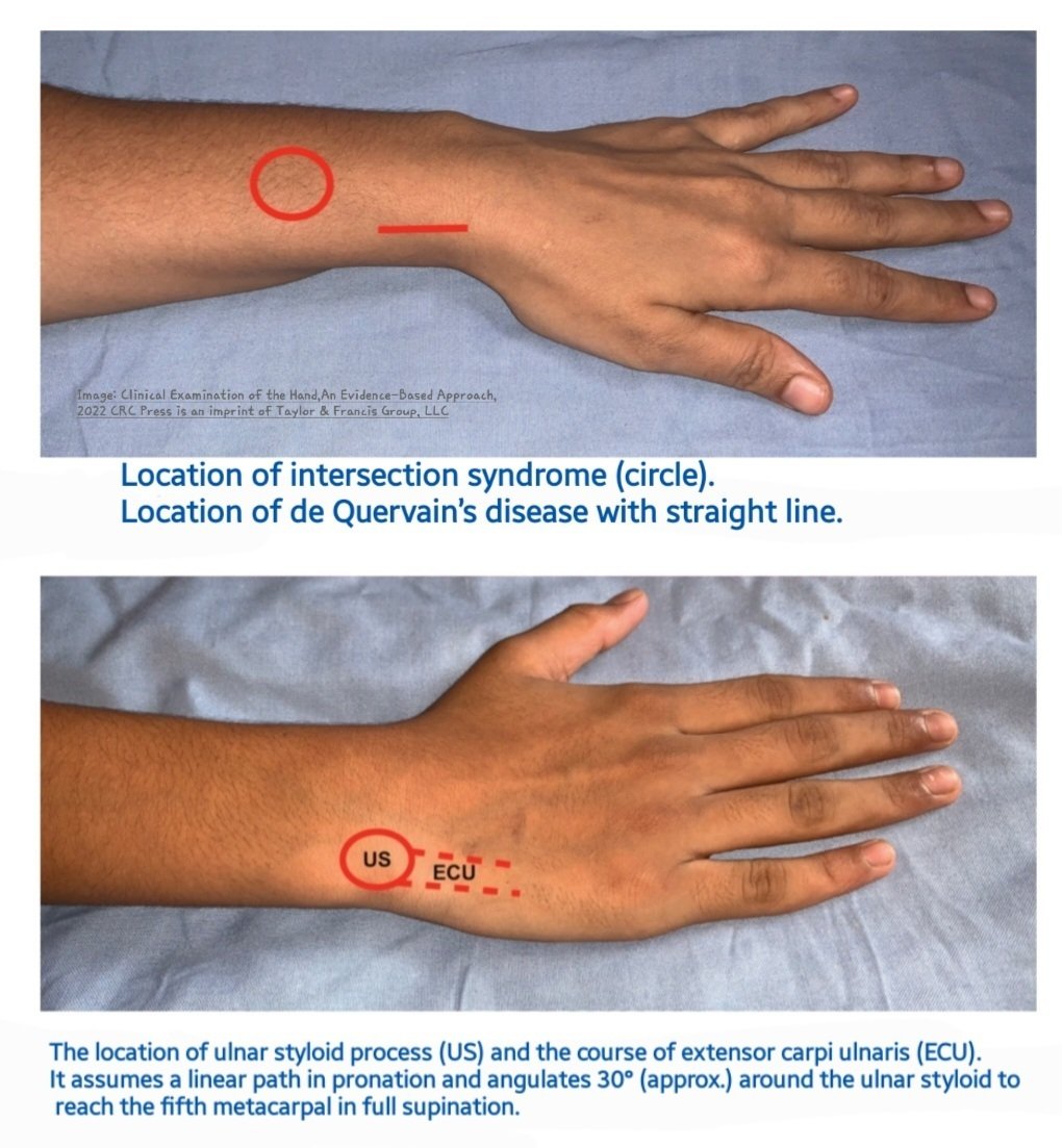 Differentiating between intersection syndrome and de Quervain’s disease and identification of ulnar styloid process and extensor carpi ulnaris is very important & in this regard clinical exam is very helpful 👍