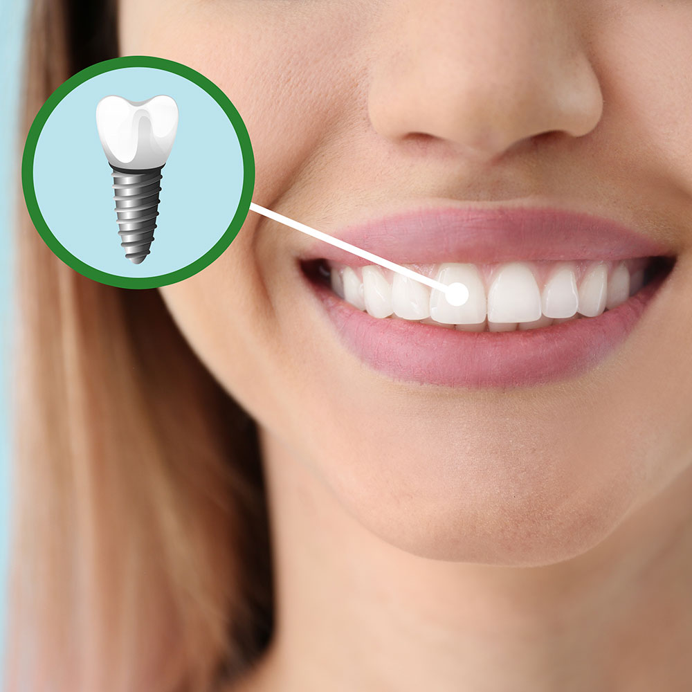 Spring is all about growth and renewal. If you've been considering dental implants to restore missing teeth, let's discuss your options and help you blossom with a confident smile. 🌱🦷 #DentalImplants #SmileRestoration
