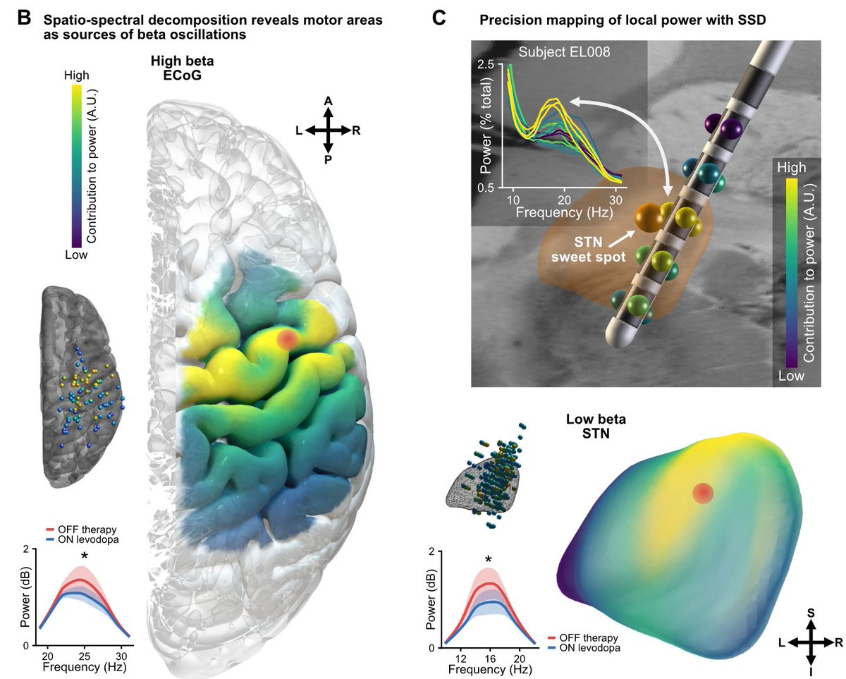 Localization with @leaddbs revealed spatial peaks of local power in motor cortex. At the level of STN, beta power peaked within 0.5 mm of the previously described DBS sweet spot. See 16 contact high-density STN recording in panel C.