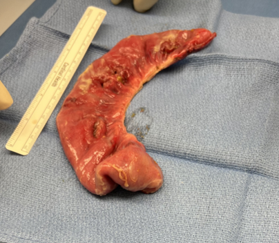 5-year-old with abdominal pain and CT showing two colonic masses and stomach debris undergoes colonoscopy, resulting in post-procedure pneumoperitoneum. What led to the perforations? @edcastilloleon @josemgarza @BenjamminGold bit.ly/48ivJTe #quickpoll
