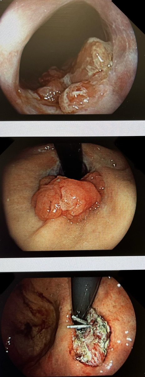 Cardial ESD in cirrhotic patient with PHT   (Non candidate for surgery). Do you perform ESD in this situation? #GITwitter #MedEd #Endoscopy #Endoscopia @DigValdecilla @SEEDendoscopia @sepdigestiva