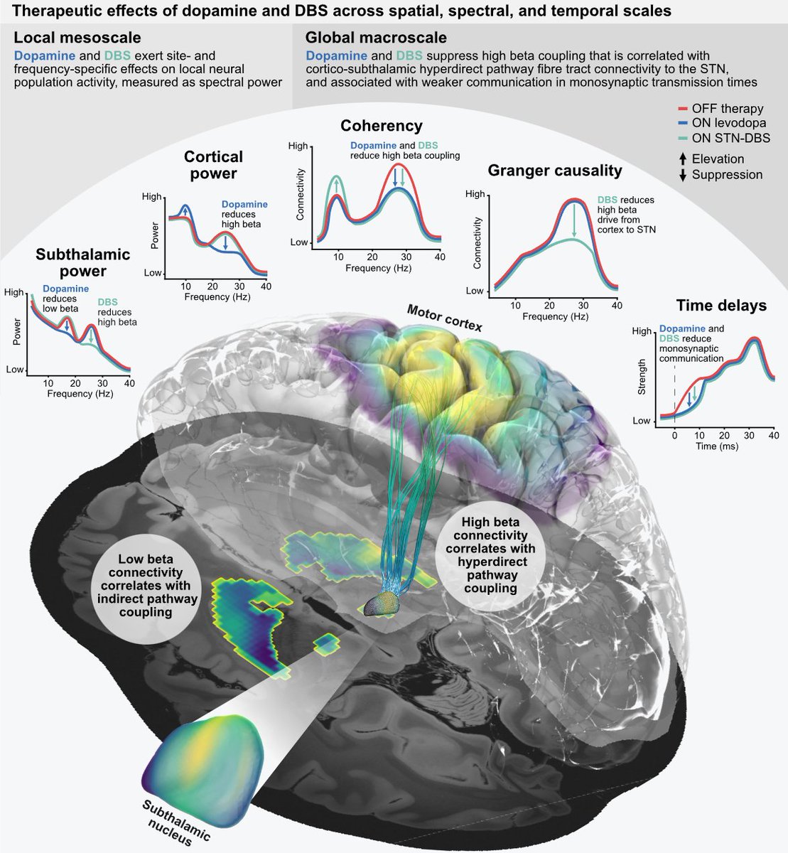 Preprint 🚨 This one is important for invasive #Parkinson #neurotech of the future. Deep brain stimulation suppresses oscillatory hyperdirect pathway communication. So does dopamine! Check our #Parkinson study spearheaded by @ECN_Berlin #PhD @tsbinns 🧵 biorxiv.org/content/10.110…