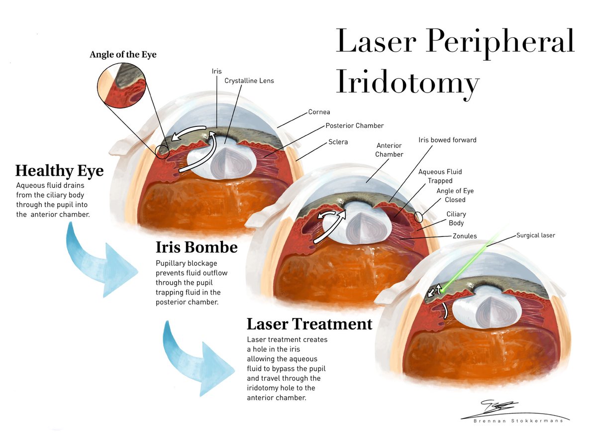 BStokkermans's tweet photo. I haven’t posted much here as it’s not paleoart, but for the past year I have been working as a medical illustrator Here are some works I am most proud of.
I should also use this opportunity to mention that I will officially be going to the Chicago college of optometry this fall! https://t.co/EwcSRnMwCK