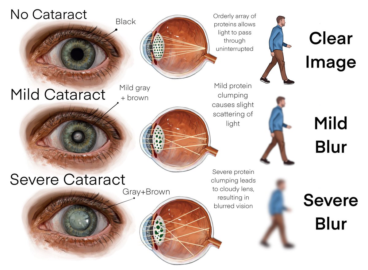 I haven’t posted much here as it’s not paleoart, but for the past year I have been working as a medical illustrator Here are some works I am most proud of.
I should also use this opportunity to mention that I will officially be going to the Chicago college of optometry this fall!