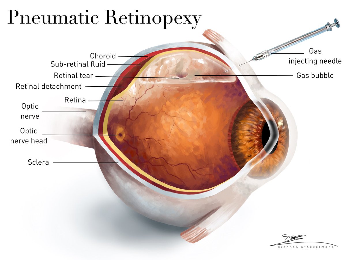 BStokkermans's tweet photo. I haven’t posted much here as it’s not paleoart, but for the past year I have been working as a medical illustrator Here are some works I am most proud of.
I should also use this opportunity to mention that I will officially be going to the Chicago college of optometry this fall! https://t.co/EwcSRnMwCK