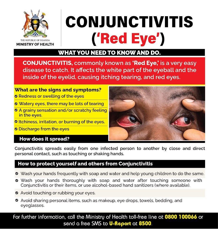 Red eyes is highly contagious but preventable. Practice clean hand hygiene with soap and clean water at all times and avoid sharing personal items. #RedEyesUG