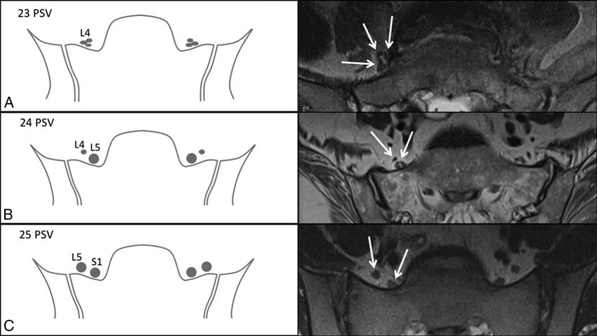How to confirm lumbosacral transition vertebrae on MRI when you don't have cervicodorsal spine screening for vertebral counting? By looking at nerve root morphology anterior to sacral ala. ▶️Sacralization of L5: 3 small nerve roots (L4) ▶️Typical configuration (no lumbarization